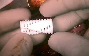 3d-odštampan-implant