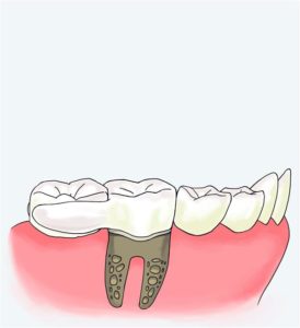 natural-dental-implants-3d-štampani-impalnt-kao-zamena-za-izubljen-zub