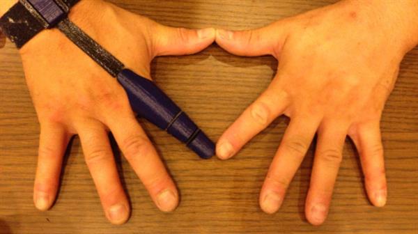 3d štampane proteze "Kinetic Finger"